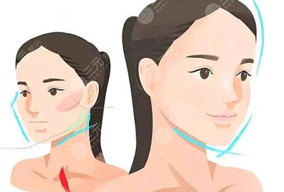 面部轮廓整形