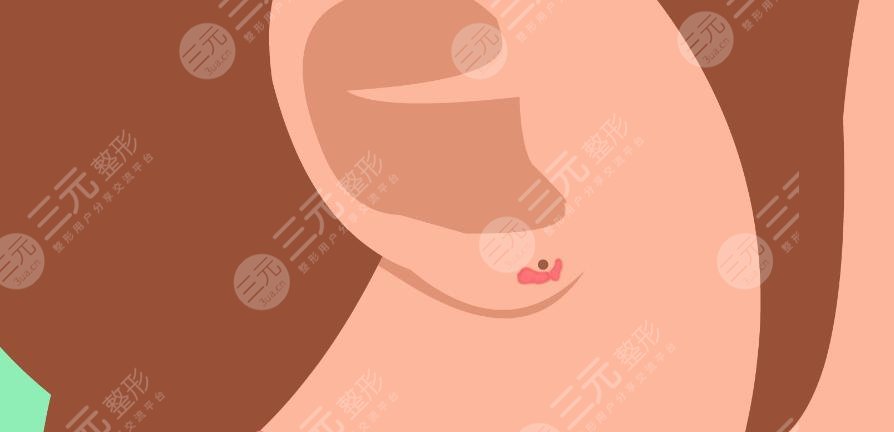 耳垂瘢痕疙瘩