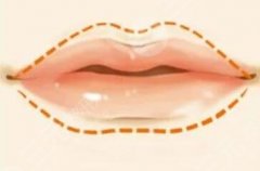 什么样的唇部适合做整形？美唇重塑指南，价格费用预览！