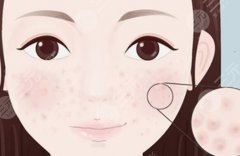 有什么微整形缓解毛孔粗大？3种轻医美帮你搞定，科普介绍！