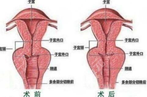 李薇  私密整形会不会有后遗症