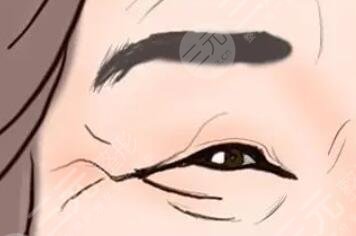鱼尾纹