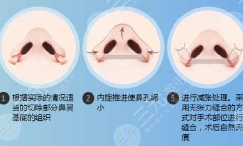 晋培红缩鼻翼多少钱？