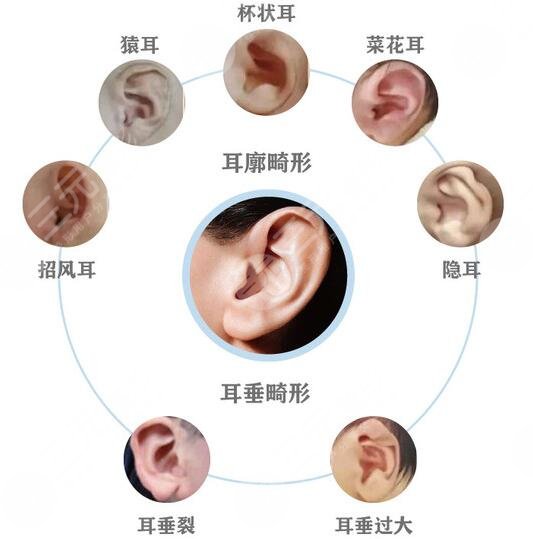 耳再造