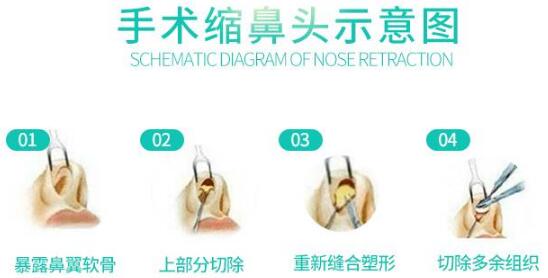 塌肉鼻头整形前后对比分享！精致美鼻的炼成指南~