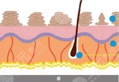 激光美白