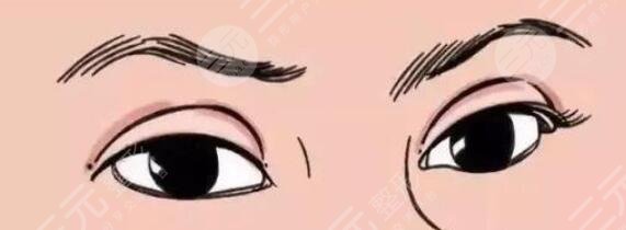 双眼皮