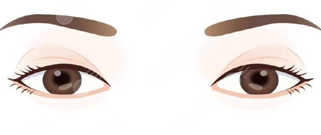 双眼皮