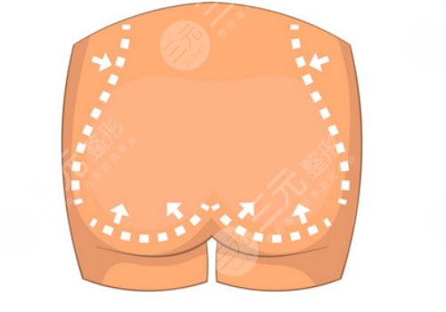 妈妈臀吸脂多久可以恢复？