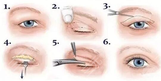 陆军总医院整形美容科双眼皮整形案例