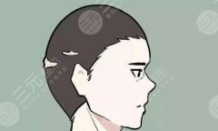 袁玉坤植发如何?附医生信息介绍和植发案例分享 袁玉坤植发如何?附医生信息介绍和植发案例分享