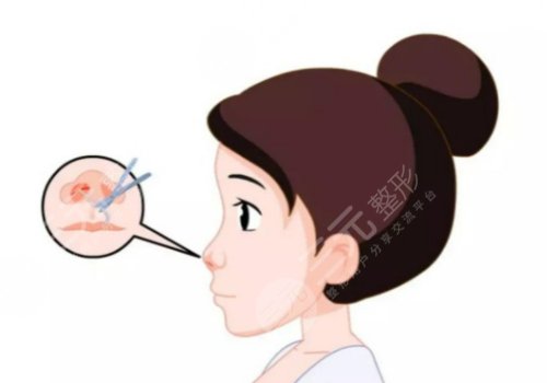 翘鼻和直鼻哪个好看