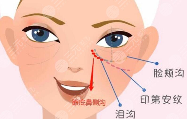 印第安纹填充胶原蛋白