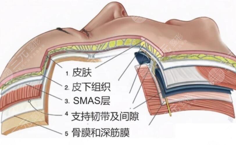 筋膜悬吊