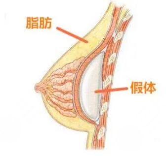 做完假体隆胸手术后求美者需要怎样护理?