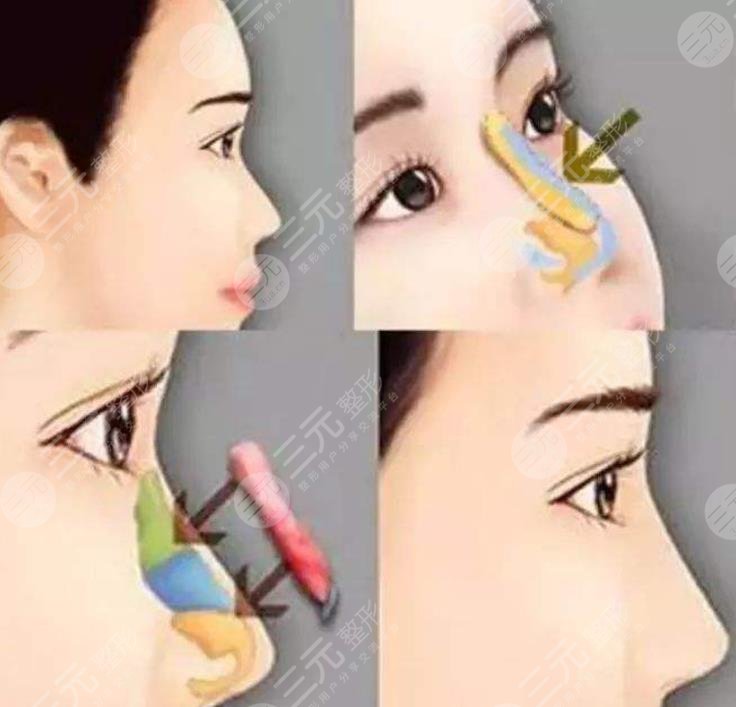 上海第六人民医院整形科隆鼻案例