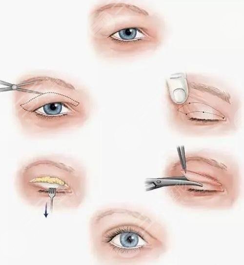 双眼皮分为哪几种类型图片