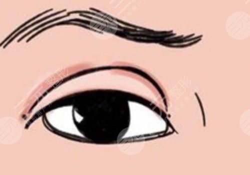 割双眼皮需要多少钱一次