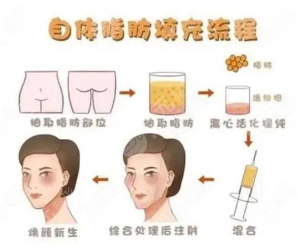 上海华东医院整形美容科自体脂肪填充面部案例