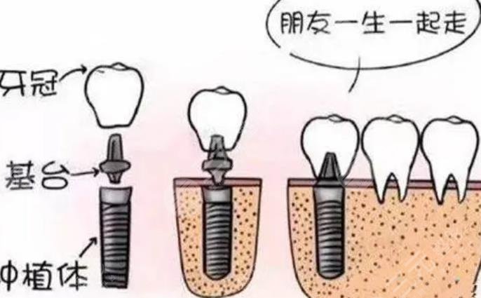 上海新华医院牙科牙齿种植案例