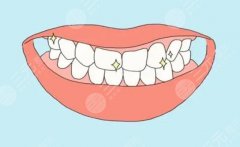 牙齿整形做义齿修复好吗？牙齿缺失这样做！价格费用查询~