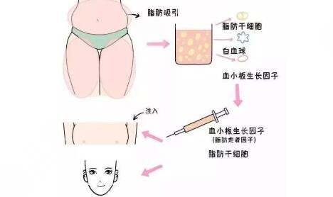 脂肪填充面部