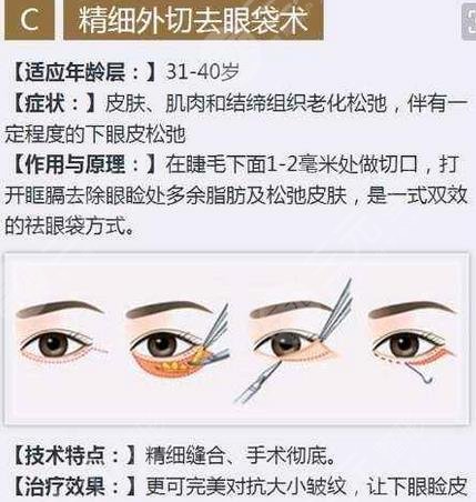 上海六院整形外科眼袋去除案例：