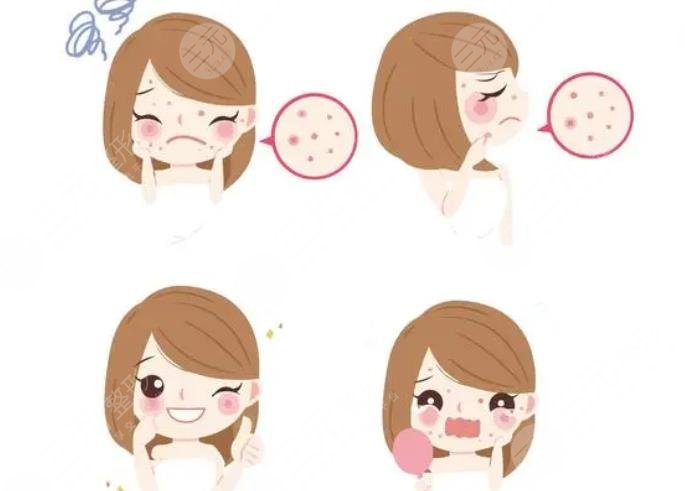 北京空军总医院点阵激光缓解痘坑案例