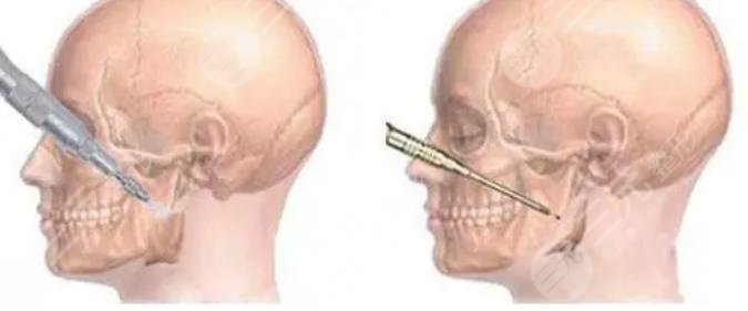 华山医院颌面外科下颌角矫正案例