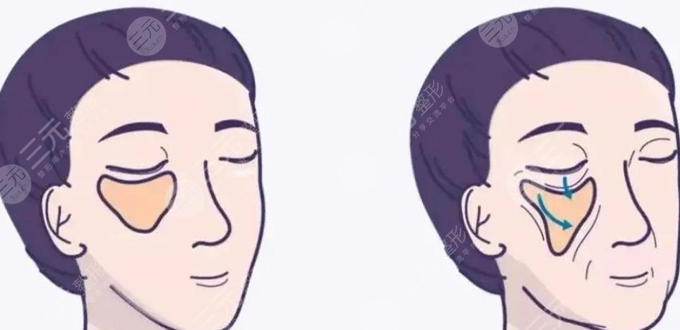 面部提升