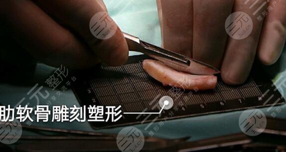 综合鼻和肋骨鼻各自的优势有哪些?