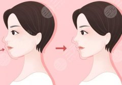 凸嘴整形手术前后对比图解！骨性or牙性？术前必看科普~