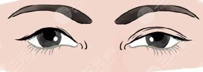 修复双眼皮