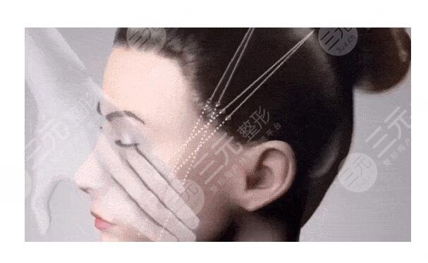 美国强生鱼骨线雕多少钱