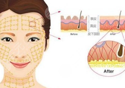 韩国美迪塑线雕能维持几年