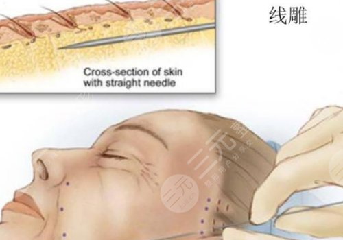 韩国美迪塑线雕能维持几年