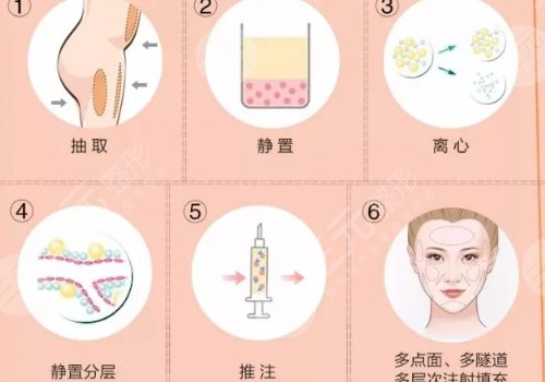 詹炜卿医生脂肪填充价格