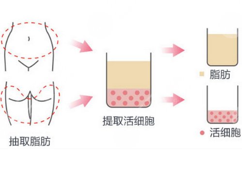 詹炜卿医生脂肪填充价格