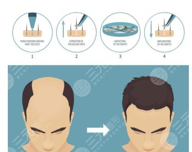 东莞人民医院植发案例分享