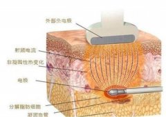 黄金微针多久可以化妆？美肤抗衰性价比之选，术前术后常识科普！