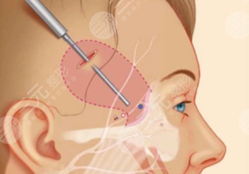 微拉美是什么整容项目