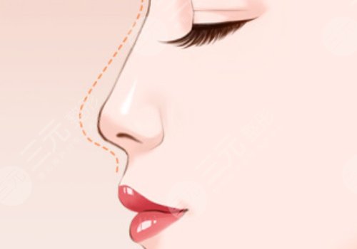 广东省第二人民医院徐翔医生鼻子做的好吗?