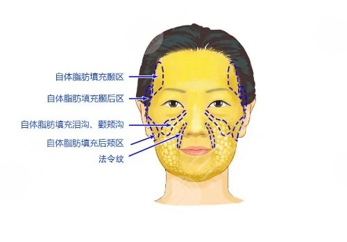 冯志丹面部脂肪填充案例