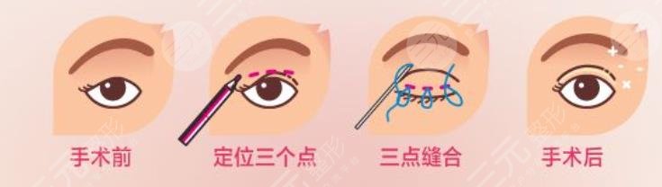 修复双眼皮