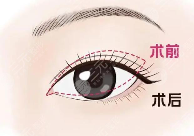 双眼皮