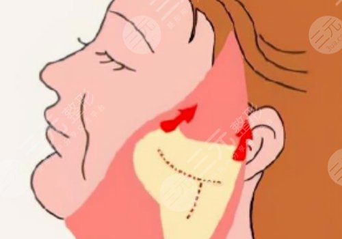 广州陈兵拉皮手术效果如何