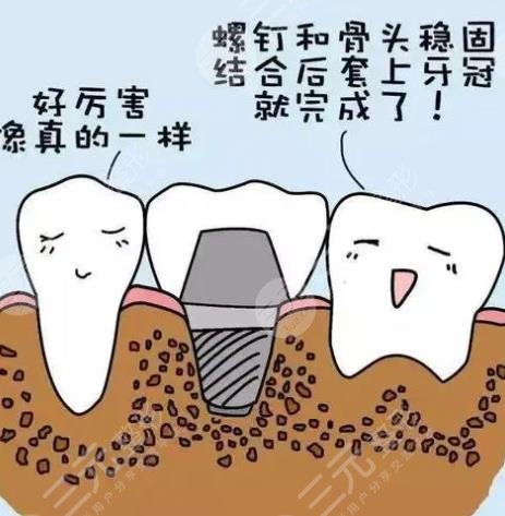 上海长海医院口腔科牙齿种植案例