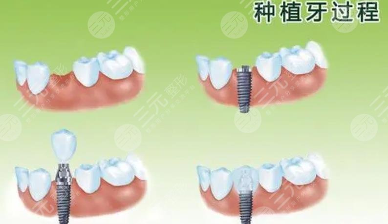 上海长海医院种牙案例