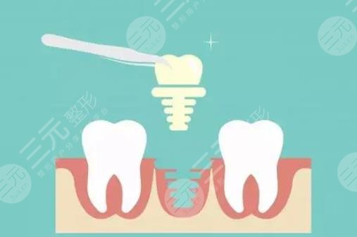 牙齿种植