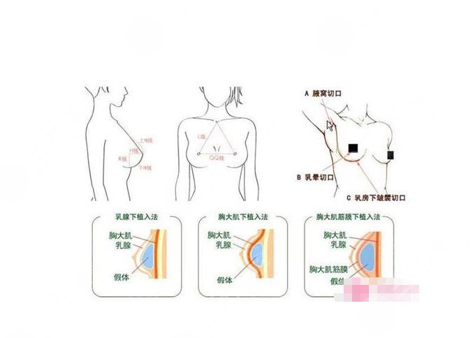 中山一院整形外科乳房再造多少钱
